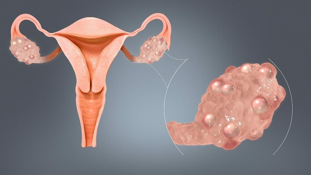 What is PCOS ?